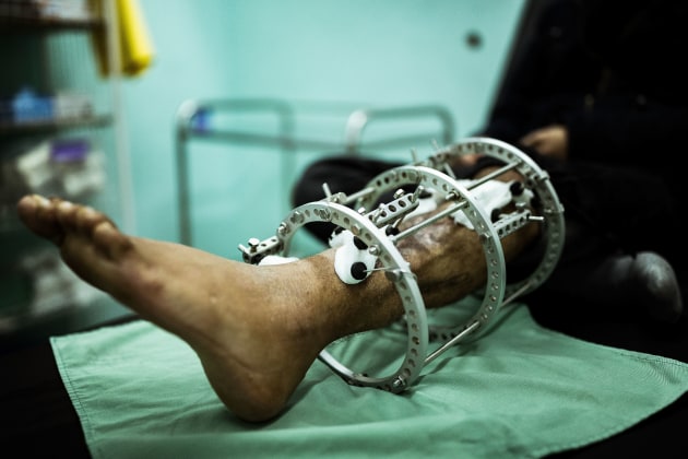 &copy; Darrian Traynor, from the series, 'More than skin deep'. GAZA. 3rd March 2020. Nasser Kheel has his Ilizarov apparatus and wound cleaned at the MSF Clinic in Gaza. Before the injury he had tried to commit suicide by drinking poison because of the oppressive conditions. Nasser still has these thoughts.

He has no expectations for the future.