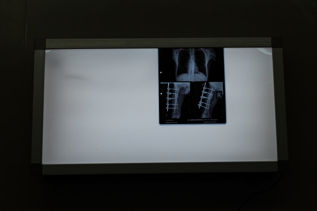 &copy; Darrian Traynor, from the series, 'More than skin deep'. GAZA. 4th March 2020. At Al-Awda hospital, patients suffering from osteomyelitis are kept in isolation rooms to treat infection. No new bone plantations can be performed while the infection is present. An x-ray shows the injury of 28-year-old father of four, Ismail Abu Wared. He is in Al-Awda to have an assessment done on his injury and external fixator after spending weeks in isolation fighting infection.